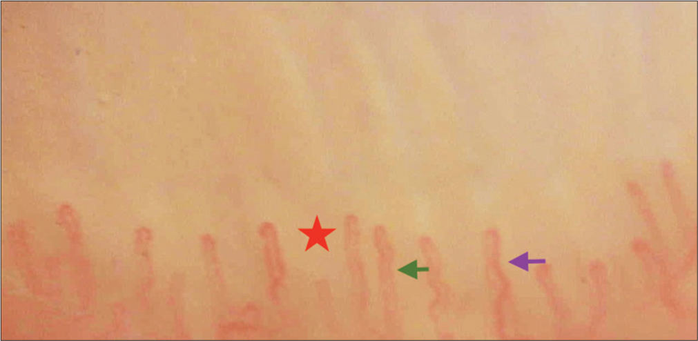 Nailfold capillaroscopy of healthy control with metabolic syndrome showing dilated capillary (purple arrow), tortuous capillary (green arrow) and capillary dropout (red star).