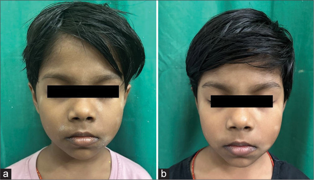 (a) Multiple well defined hypopigmented macules of varying size with mild scaling present over the face. (b) Decrease in the number of macules and complete resolution of scaling after twice daily application of crisaborole 2% ointment for 28 days.