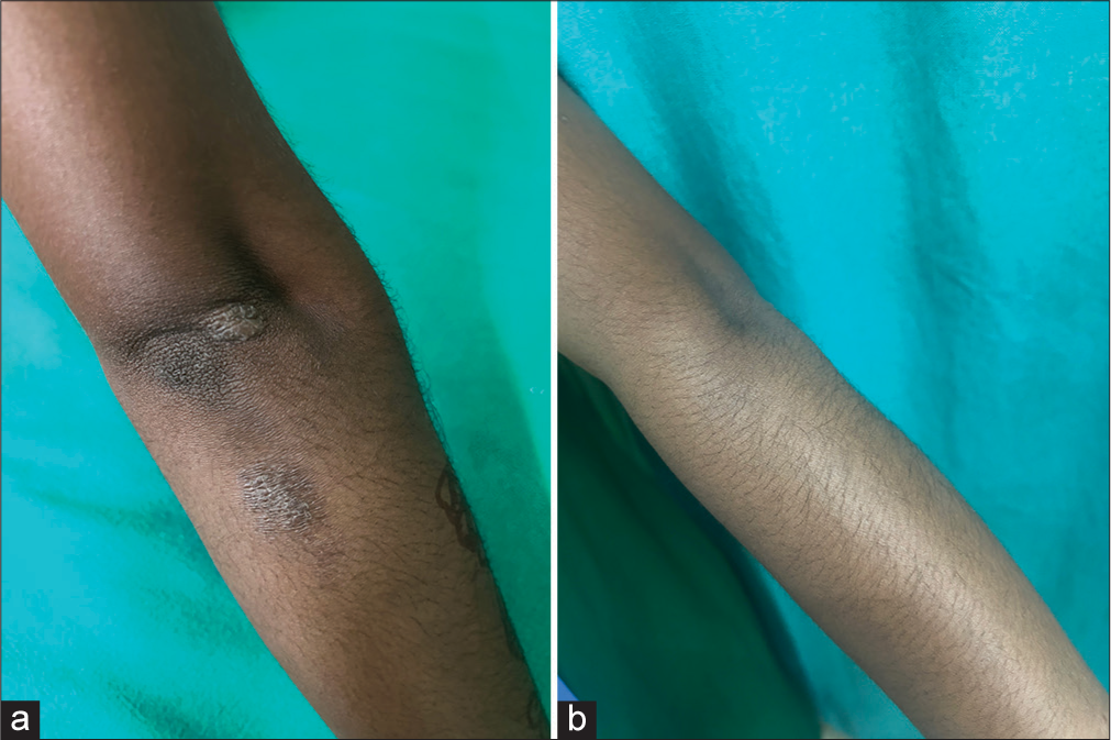 (a) A well defined lichenified plaque measuring 1 × 2 cm over the extensor aspect of the left hand. (b) Complete resolution of lichenification and scaling over the lesion after twice daily application of crisaborole 2% ointment for 28 days.