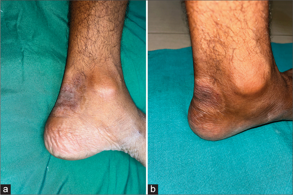 (a) A well-defined, oval, erythematous to hyperpigmented plaque present over the posterior aspect of the right foot with scaling. (b) Mild improvement was seen in the form of a decrease in erythema and scaling of the plaque after twice daily application of crisaborole 2% ointment for 28 days.