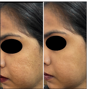 Pre-treatment score – 20 and Post treatment score – 9.