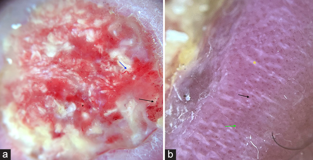 Dermatoscopy (using dermatoscope IDS-1100, under polarised light with ×10 magnification) in giant ulcerating pilomatricoma showing (a) dotted vessels (black arrow) and linear irregular vessels (blue arrow), (b) irregular whitish streaks (asterix), few reddish pink homogenous areas (green arrow) and dotted vessels (black arrow), IDS: Illuco dermatoscope.