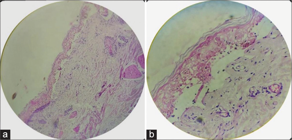 (a and b) Histopathology showing necrotic and apoptotic keratinocyte in the stratum spinosum and stratum basale in the epidermis with subepidermal blister with melanin in the cavity of the blister [Haematoxylin and Eosin] (a) 10X, (b) 40X.