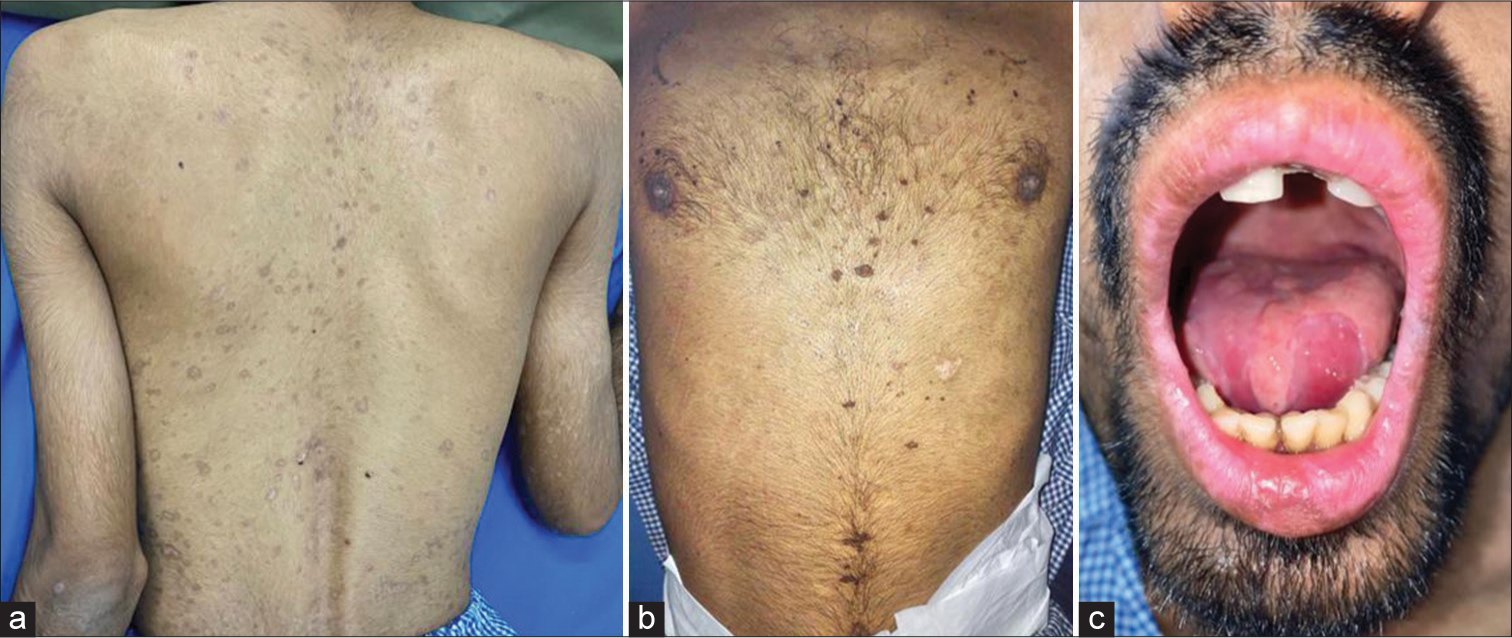 Post-treatment photograph after 6 days of 2nd dose of etanercept shows healed erosions, reepithelisation of the lesions on (a) back, (b) chest and (c) oral mucosa.