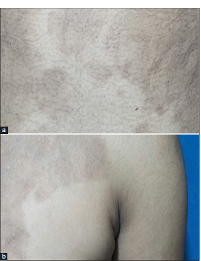 (a, b) Post-inflammatory hyperpigmented macules due to resolved lesions of pemphigus vulgaris, over abdomen and left axilla with a resolution of miliaria after 2 weeks of follow-up.