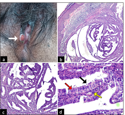 (a) Gross appearance of the vulvar lesion (white arrow): Solitary, well-defined, flesh to red-coloured, firm nodule, measuring 1 × 1 cm, with slightly eroded surface on the right labia minora. (b) Scanner view (×4) (Haematoxylin and Eosin) showing a dermal cystic adnexal tumour with numerous papillary projections; (c) Low-power view (×10) (Haematoxylin and Eosin) showing papillary projections with cystic spaces. (d) High-power view (×40) (Haematoxylin and Eosin) showing numerous papillary projections lined by a peripheral layer of myoepithelial cells (yellow arrow) and a luminal layer of tall columnar cells (red arrow) showing decapitation of secretion (black arrow).