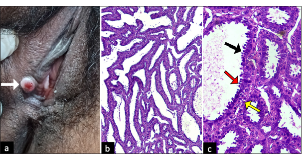 (a) Gross appearance of the vulvar lesion (white arrow): a well-circumscribed, flesh to red-coloured, nodule, with eroded surface on the right labia minora. (b) Low-power view (×10) (Haematoxylin and Eosin) showing papillary projections with cystic spaces. (c) High-power view (×40) (Haematoxylin and Eosin) showing numerous papillary projections lined by a peripheral layer of myoepithelial cells (yellow arrow) and a luminal layer of tall columnar cells (red arrow) showing decapitation of secretions (black arrow).