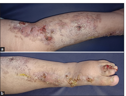 (a) Linear hyperkeratotic plaques with irregular borders and a central furrow noted along the left lower limb. (b) Verrucous, hyperplastic plaques noted over the dorsum and third toe of the left foot.