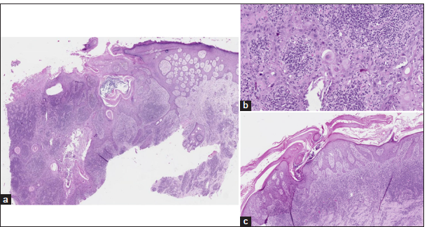 (a) Pseudoepitheliomatous hyperplasia with the dermis shows a dense lymphoplasmacytic infiltrate (H&E 5x). (b) Pleomorphic and squamoid cells have vesicular nucleus with eosinophilic cytoplasm (H&E 20x). (c) Epidermis showing infundibular plugging with cornoid process (H&E 5x). H&E: Haematoxylin and eosin.