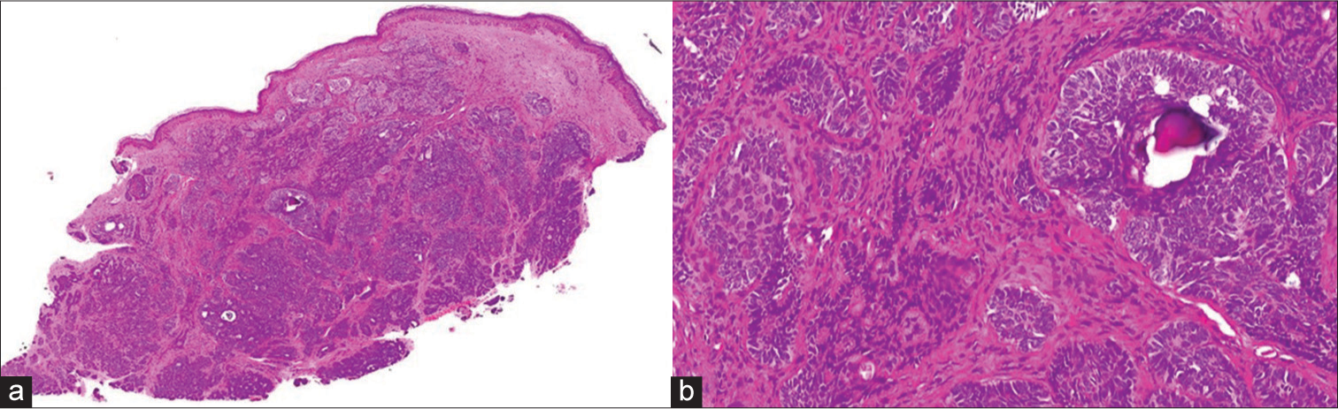 (a) Dermis shows a multilobulated, circumscribed neoplasm arranged as nests, cords, reticular and cribriform pattern, with few papillary mesenchymal bodies (haematoxylin and eosin [H & E] ×2). (b) Bland appearing trichoblastic cells with peripheral palisading, with no evidence of atypia or mitosis (H & E ×20).