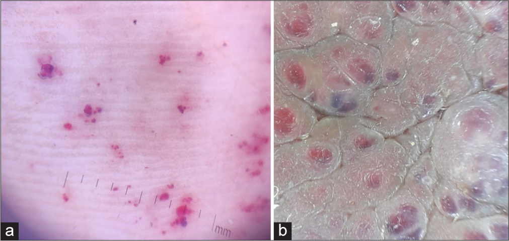 (a) Red lacunae on dermoscopy of palmar lesions. (b) Red lacunae intermingled with a white veil on dermoscopy of scrotal lesions.