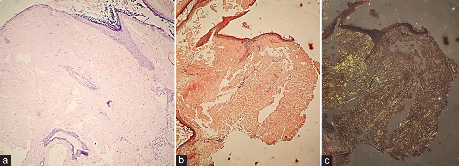 (a) Histopathology showing atrophied epidermis with dense, amorphous, eosinophilic, hyaline extracellular deposits in the dermis (H&E ×20). (b) Amyloid deposits showing orangered colour with Congo red stain on routine microscopy (H&E ×20). (c) Amyloid deposits showing apple-green birefringence with Congo red on polarised microscopy (H&E ×20). H&E: Haematoxylin & Eosin.