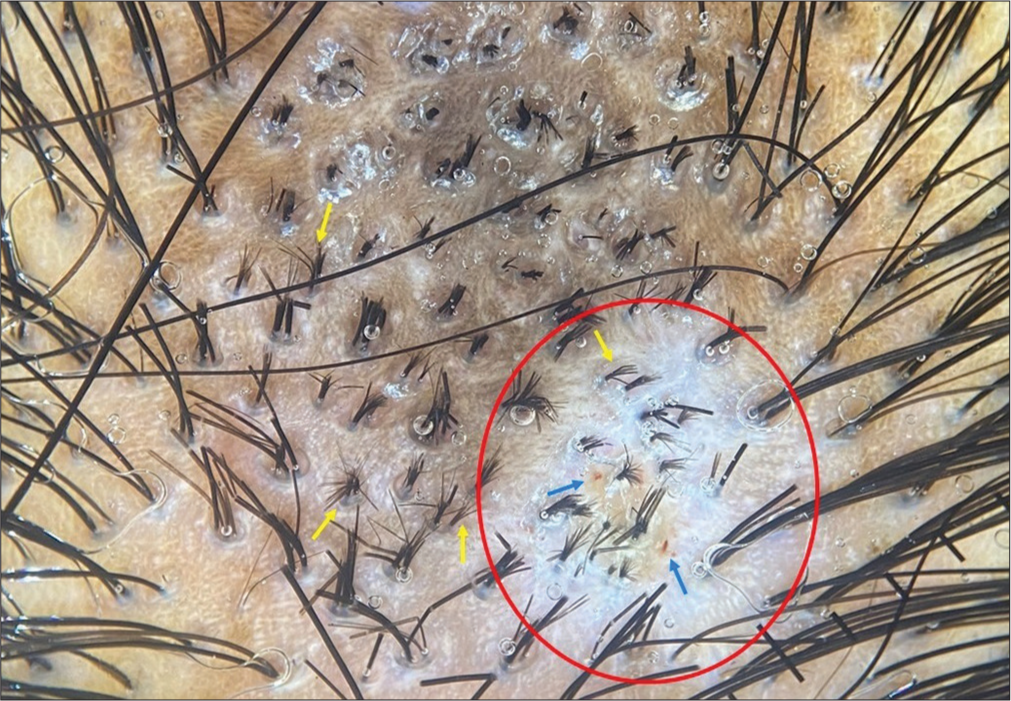 Trichoscopy (with interface liquid) (×10 magnification) shows white structureless areas (red circle) with red dots (blue arrows) and monotonous clusters of broom hairs (yellow arrows) over the entire plaque.