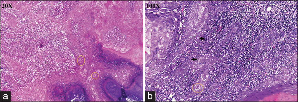 (a) Histopathological examination at ×20 showing a hyperplastic and dysplastic epithelium with tumour cells. Tumour cells are moderately differentiated anaplastic squamous cells with hyperchromatic nuclei, inconspicuous nucleoli and moderate amount of cytoplasm. Keratin pearls are seen (yellow circles). (b) Histopathological examination at ×100 showing tumour cells (black arrows) and keratin pearls (yellow circles).