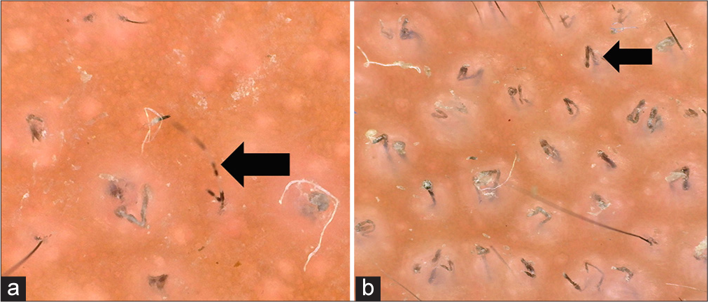 (a) Monilethrix hair (black arrow), (b) non-erupted vellus hair- pigtail hair (black arrow).