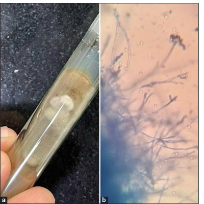 (a) Scedosporium apiospermum growing as colonies with fluffy powdery texture with a light grey to brownish colour on Sabouraud’s dextrose agar. (b) Septate hyphae with slender and branching structures, some showing conidia at their tips.